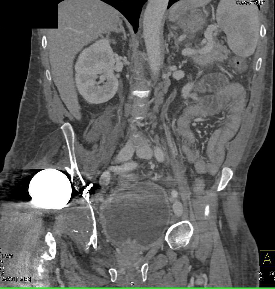 Dislocated Right Hip Prosthesis - CTisus CT Scan