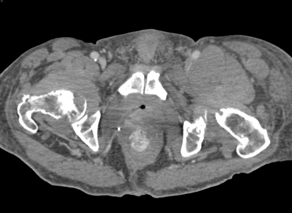 Multiple Lytic Lesions in Pelvis with Associated Sot Tissue Masses c/w Myeloma - CTisus CT Scan