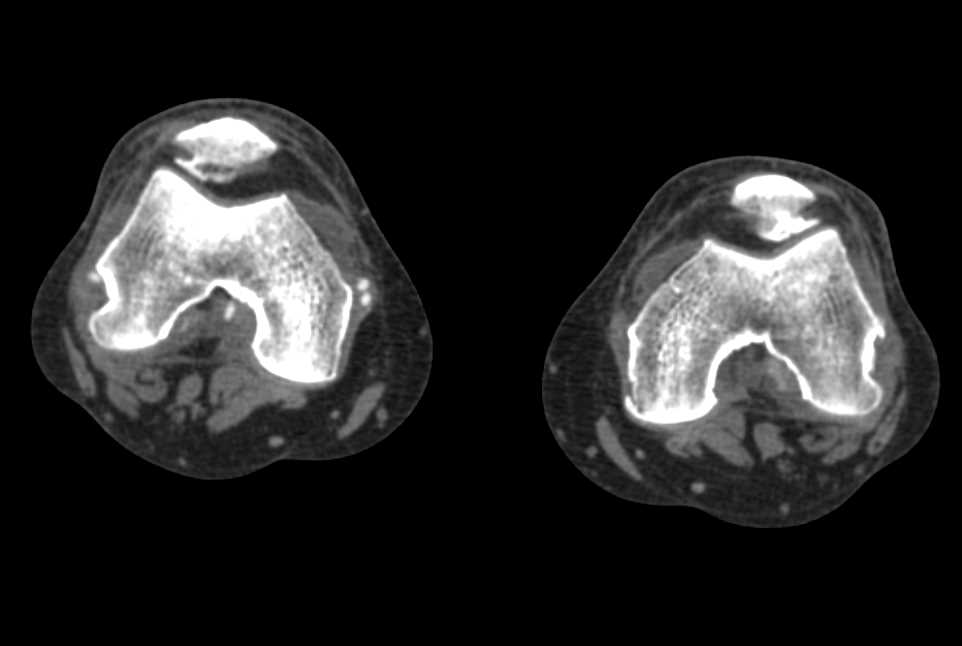 Positive Dual Energy Gout Study - CTisus CT Scan