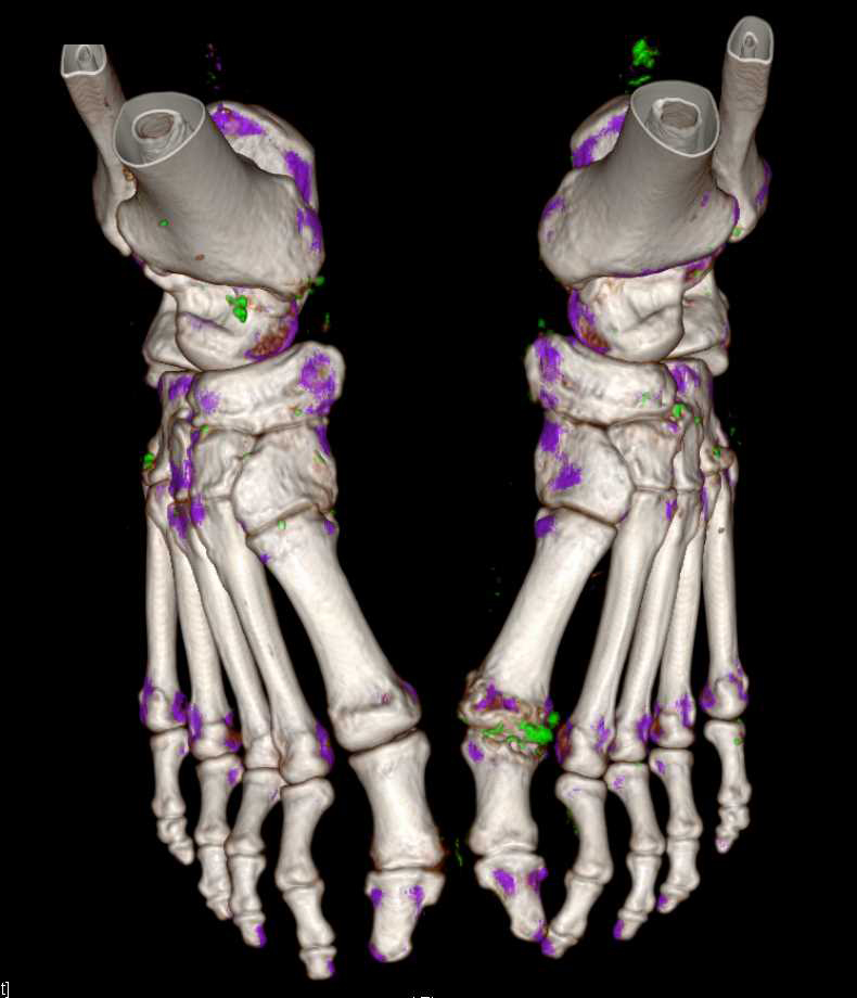 Positive Dual Energy Gout Study of Knee and Ankles - CTisus CT Scan