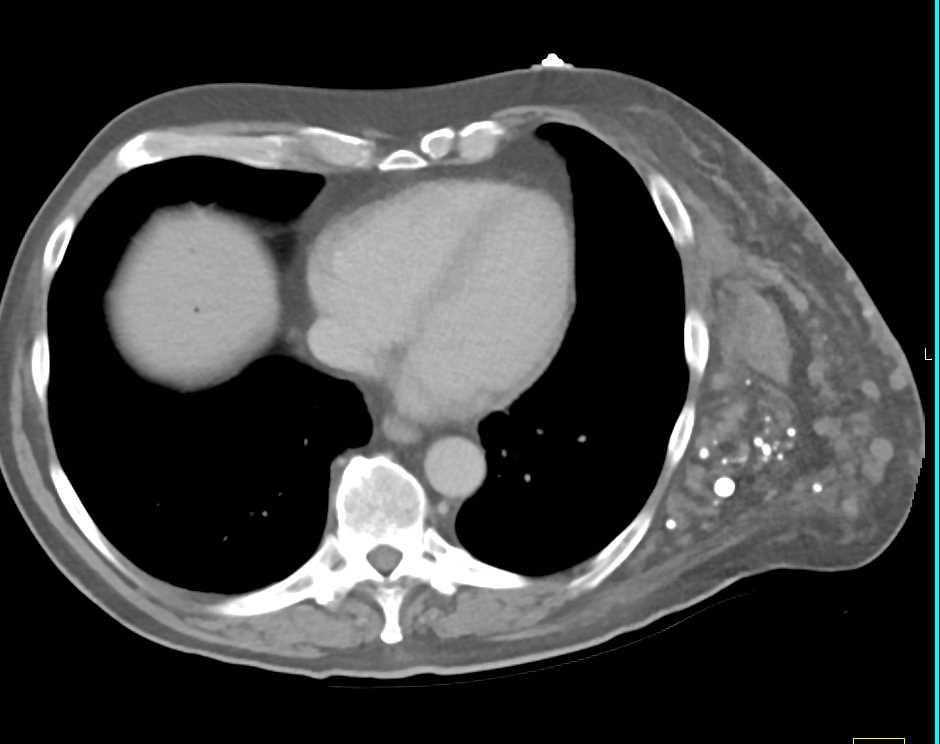 Klippel-Trenaunay-Weber (KTW) Syndrome with Multiple Hemangiomas - CTisus CT Scan