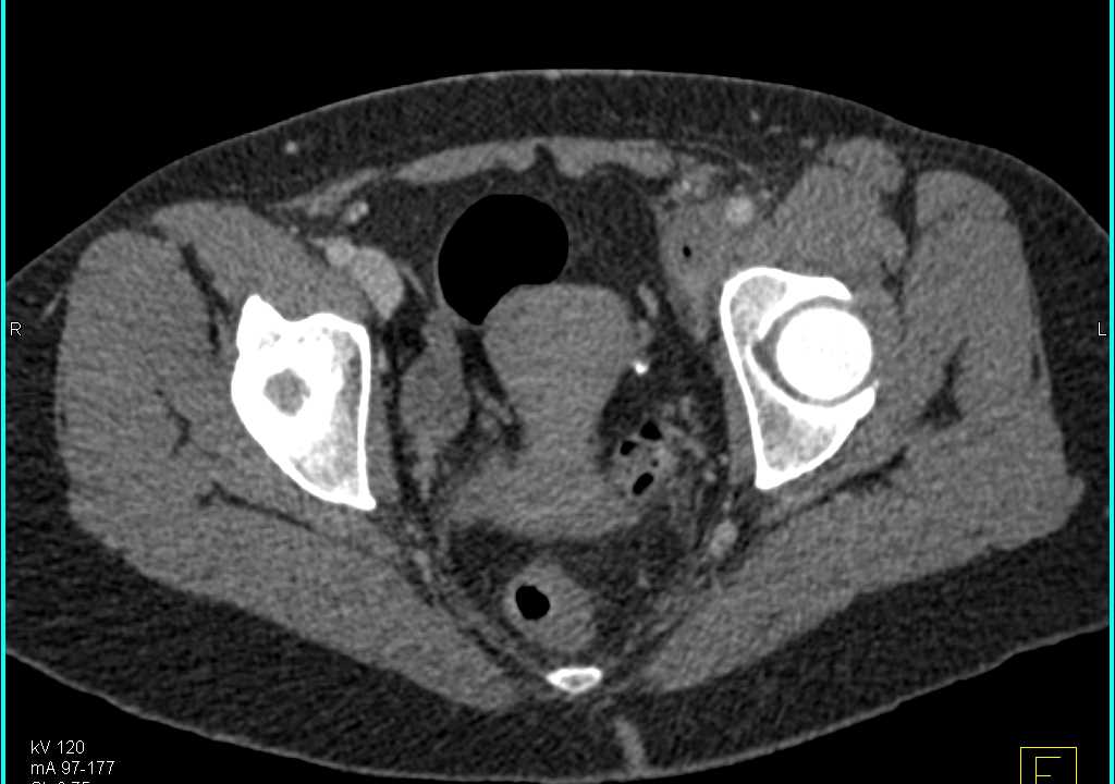 CTA with Good Vascular Map and Inguinal Adenopathy and Induration Left Groin - CTisus CT Scan