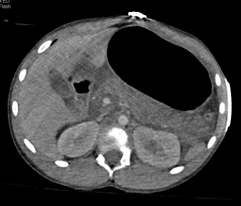 GSW with Right Femur Fracture and Injury to Right Superficial Femoral Artery - CTisus CT Scan