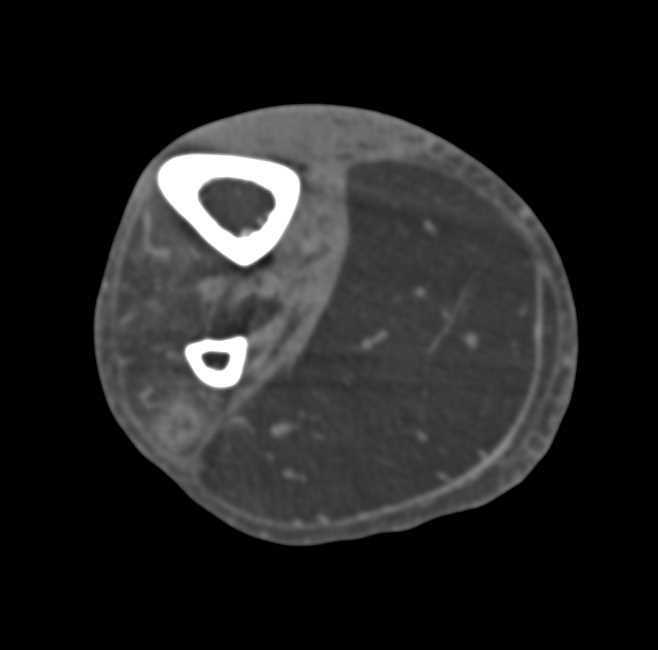 Diffuse Fatty Infiltration of Muscle - CTisus CT Scan