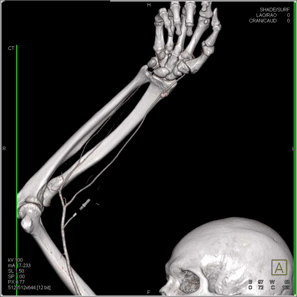 Pseudoaneurysm Distal Radial Artery - CTisus CT Scan