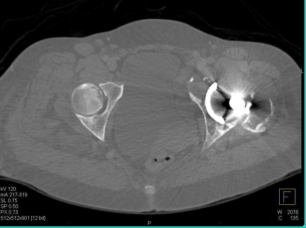 Failing Left Total Hip Replacement - CTisus CT Scan