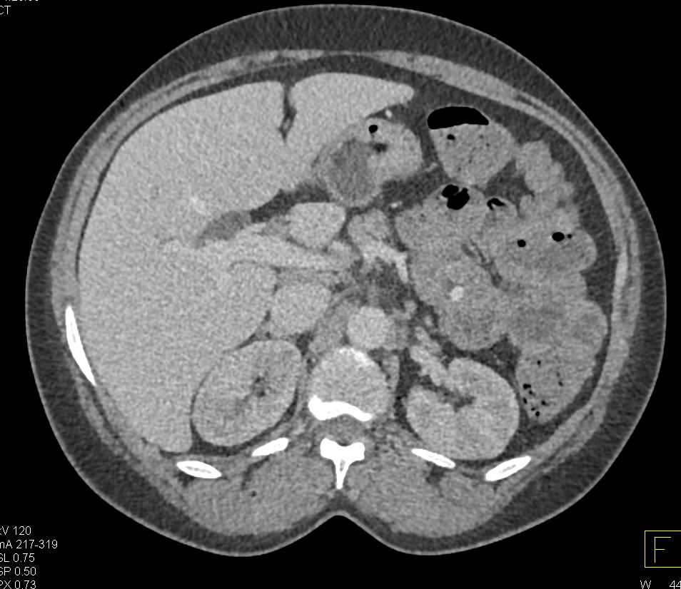 Sickle Cell Disease with Pseudotumor Left Hemipelvis - CTisus CT Scan