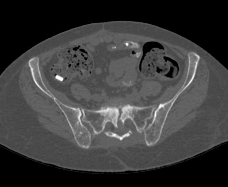 Chronic Sacral Fracture with Periosteal Rxn - CTisus CT Scan