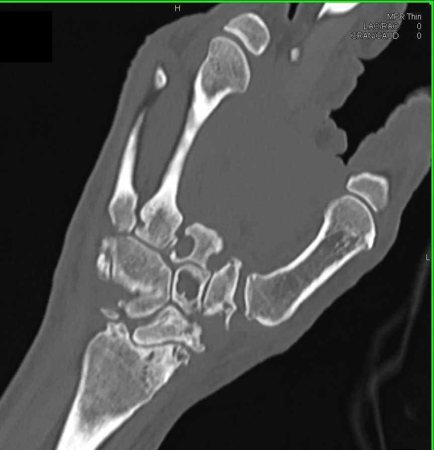 Cystic Changes Carpal Bones due to Repeated Trauma - CTisus CT Scan