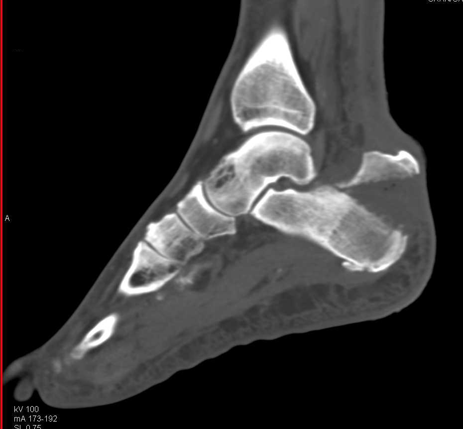 Avulsion Fracture of the Calcaneus - CTisus CT Scan