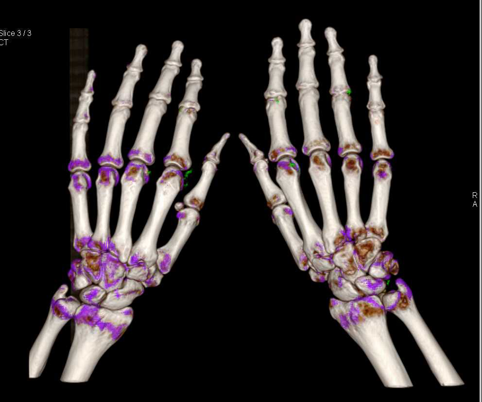 Dual Energy CT Defines Gout in Multiple Joints (Gout is Green on DE) - CTisus CT Scan