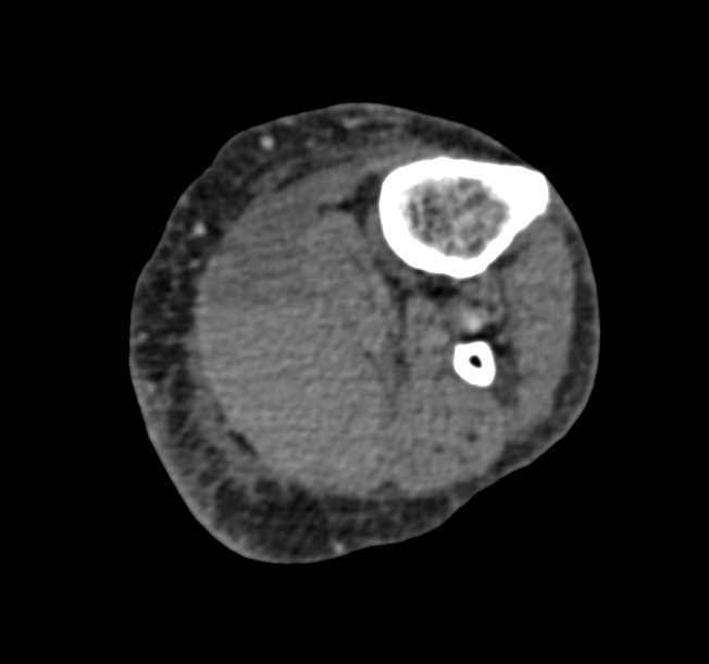 Active Bleed in Gastrocnemius Muscle - CTisus CT Scan