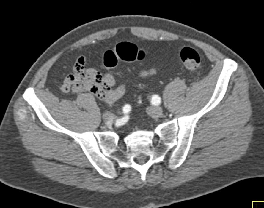 Vascular Muscle Metastases from Renal Cell Carcinoma - CTisus CT Scan