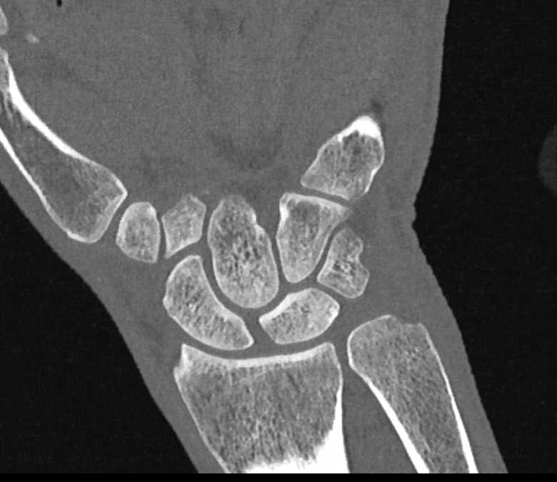 High Resolution 3D Mapping of the Carpal Bones - CTisus CT Scan