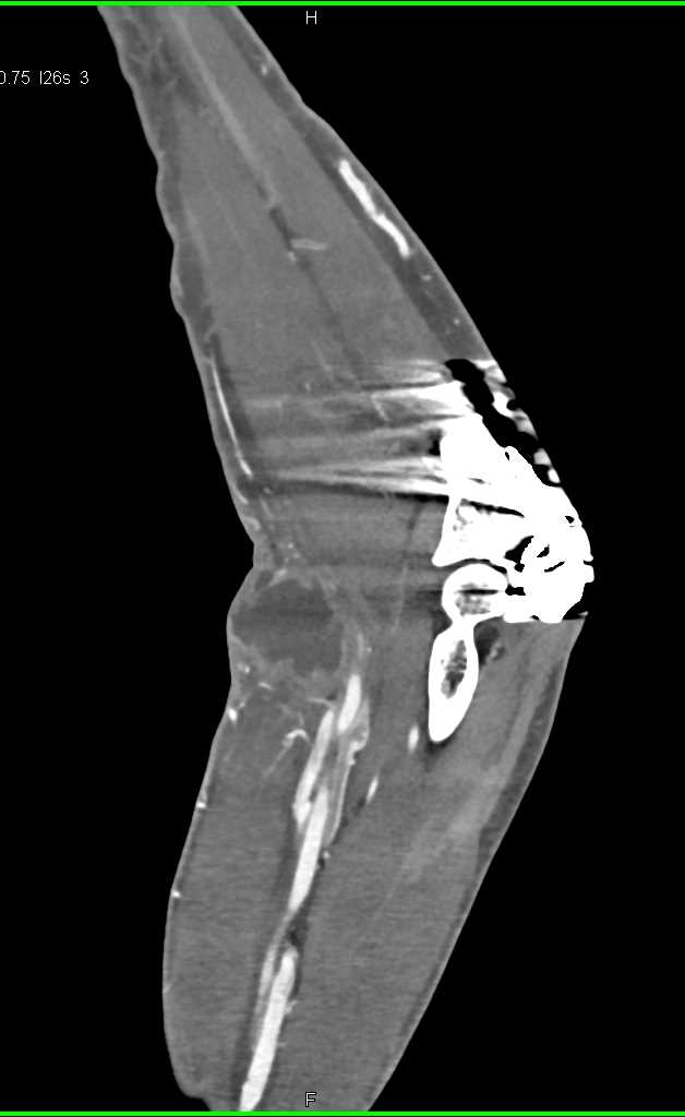 Abscess in the Antecubital Fossa - CTisus CT Scan