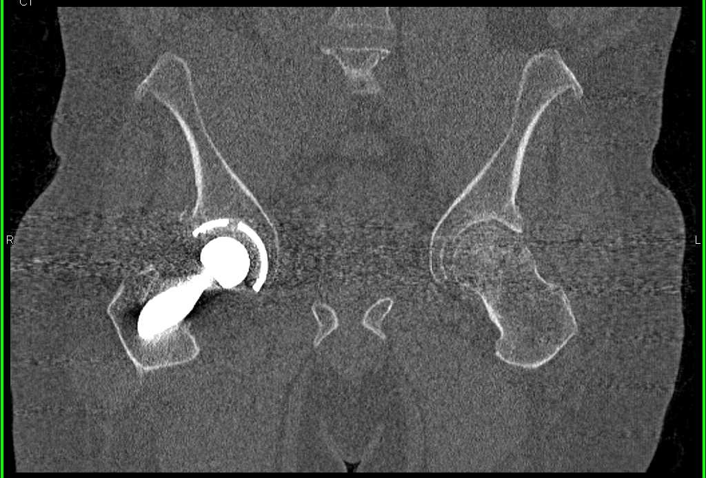 Left Total Hip Prosthesis - CTisus CT Scan