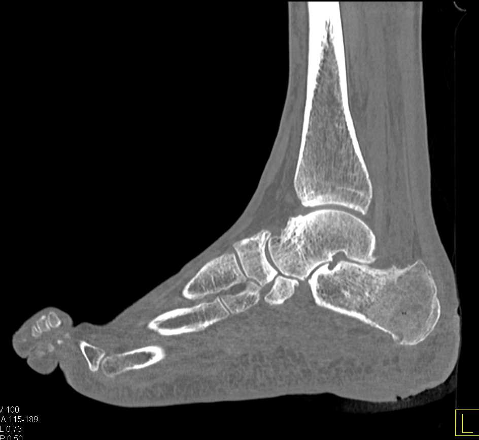 Ulceration and Infection in Soft Tissues Near the Calcaneus - CTisus CT Scan