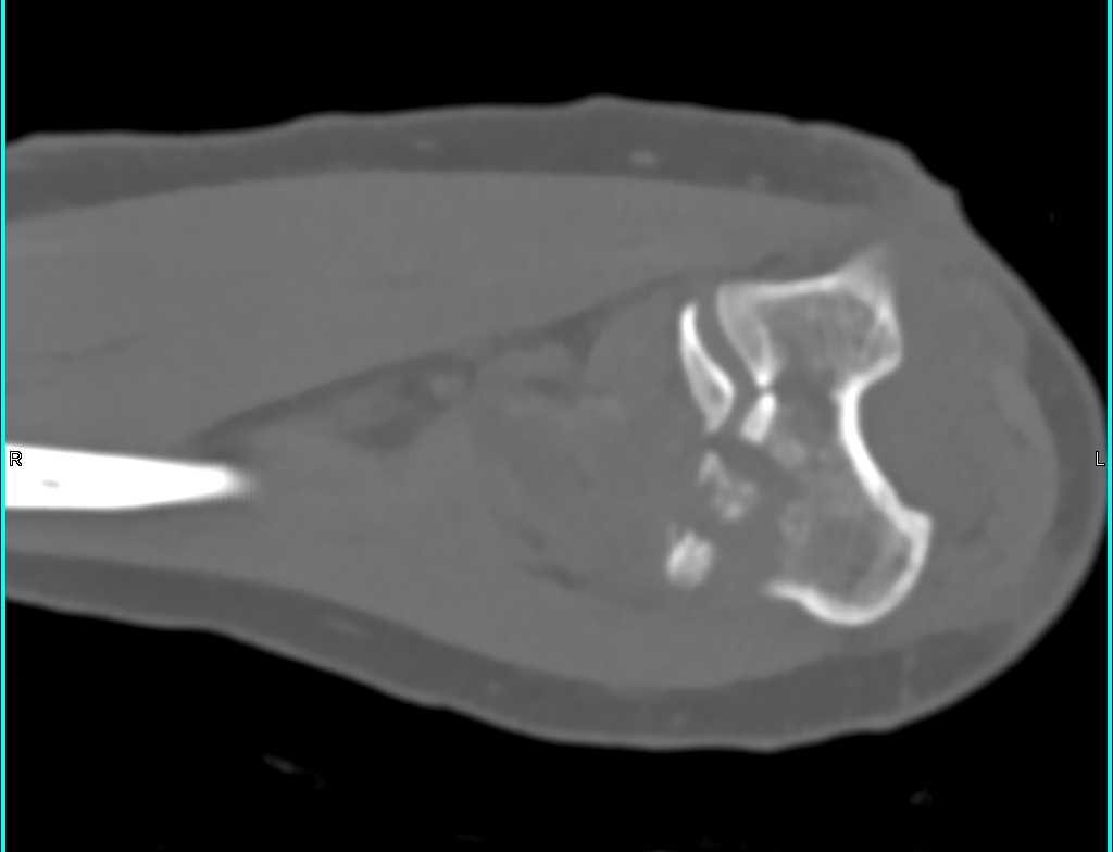 Comminuted Left Humeral Fracture - CTisus CT Scan