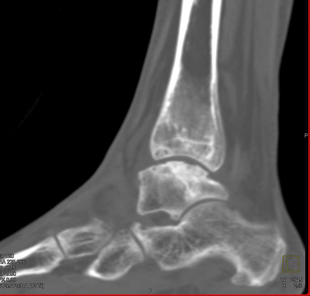 Avascular Necrosis (AVN) Talus - CTisus CT Scan