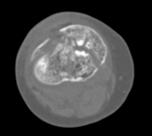 Comminuted Fracture of the Tibial Plateau in a Patient with Osteogenesis Imperfecta - CTisus CT Scan