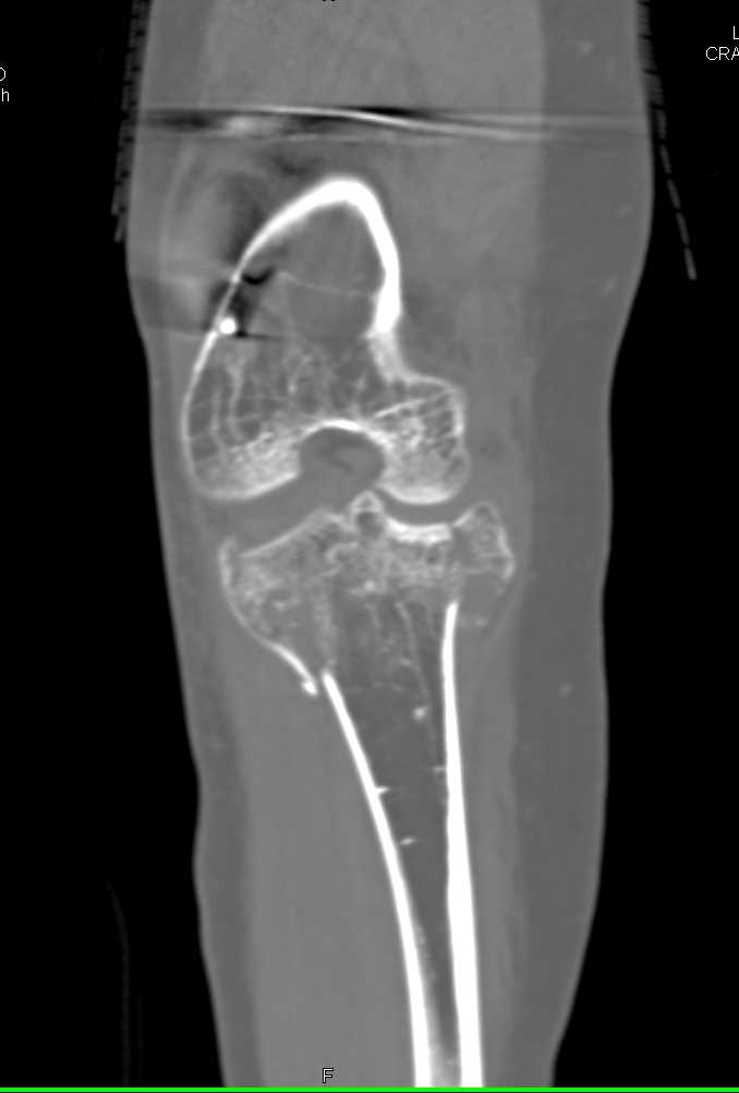 Comminuted Fracture Of The Tibial Plateau In A Patient With