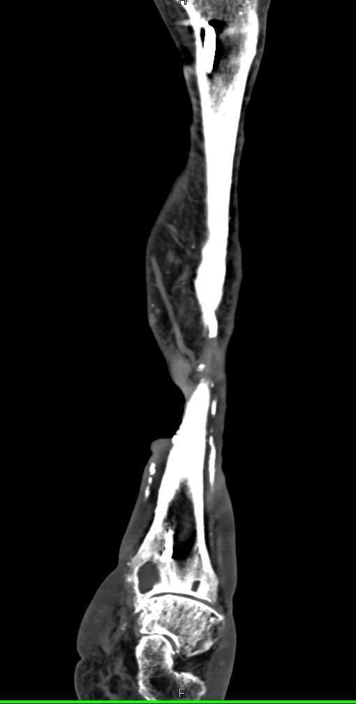 Prior Osteomyelitis at Site of Non-union with Subsequent Healing and Significant Soft Tissue and Muscle Injury - CTisus CT Scan