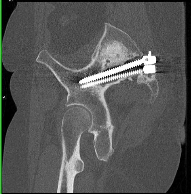 Stress Fracture with Pins Placed to Try to Improve Healing due to Nonunion - CTisus CT Scan