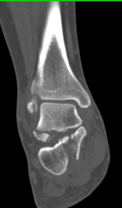 Fracture of the Talus and the Calcaneus - CTisus CT Scan