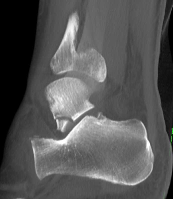 calcaneus fracture orthobullets