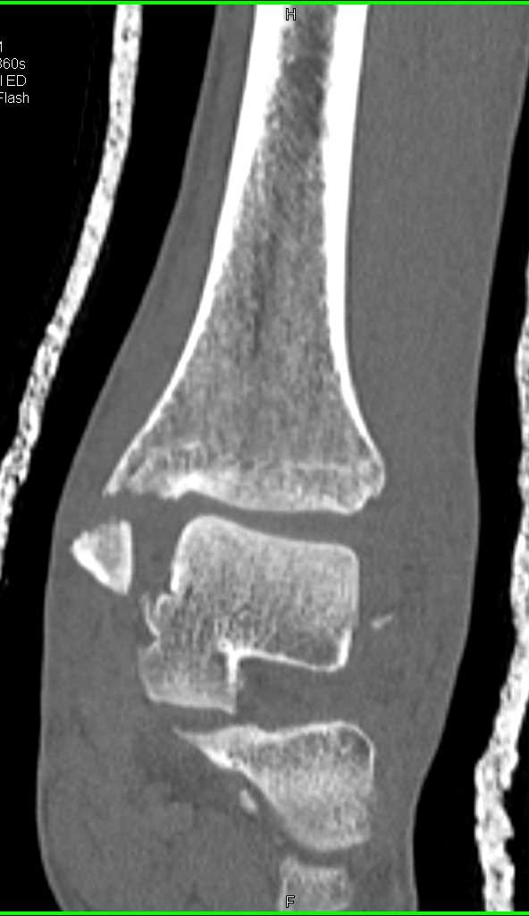 Fracture and Dislocation Ankle - CTisus CT Scan