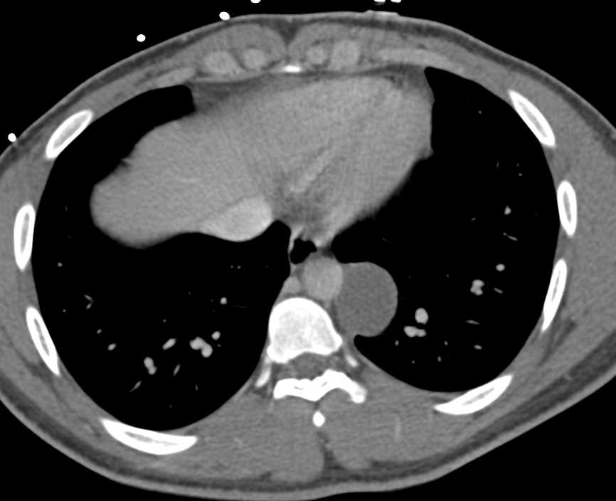 Neurogenic Cyst - CTisus CT Scan