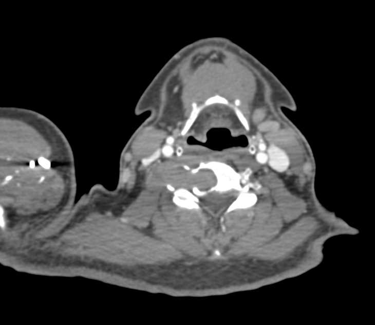 Lytic Lesion to C-Spine from Renal Cell Carcinoma - CTisus CT Scan