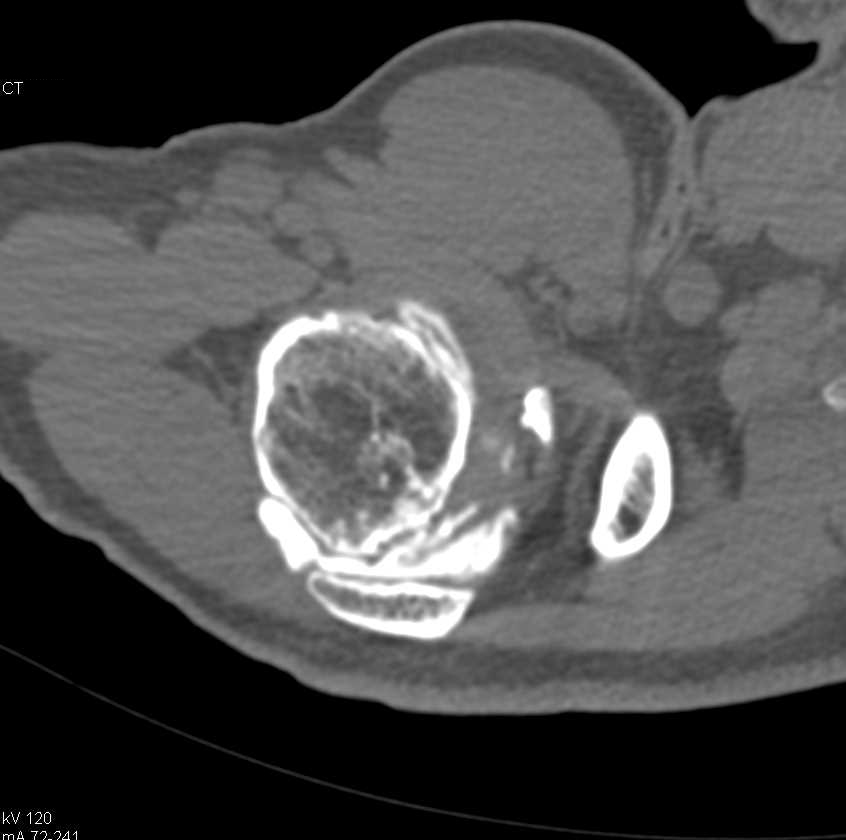 CT Arthrogram with Rotator Cuff Tear - CTisus CT Scan