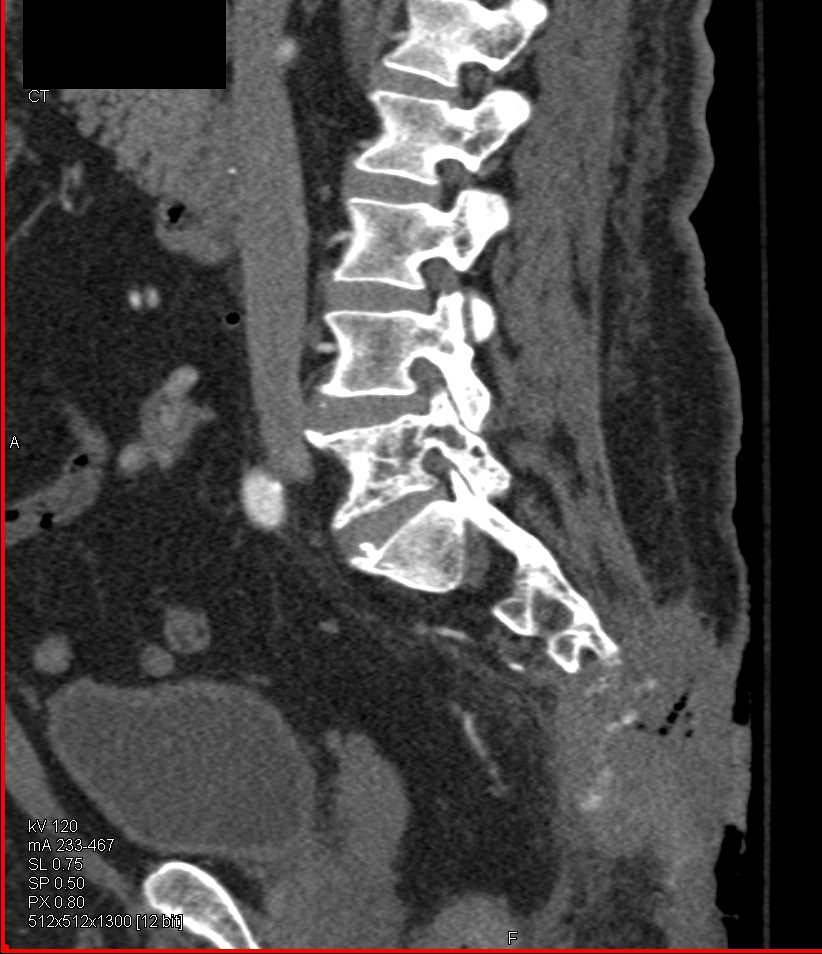 Destructive Lesion in the Sacrum due to Metastatic Adenocarcinoma - CTisus CT Scan