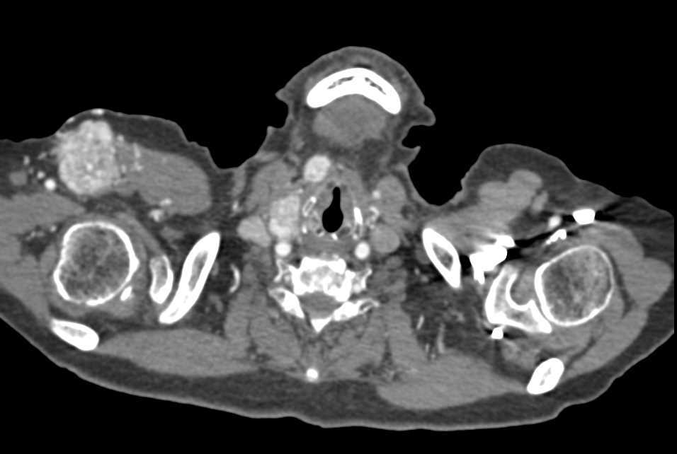 Metastatic Renal Cell Carcinoma to Muscle and the Pancreas - CTisus CT Scan