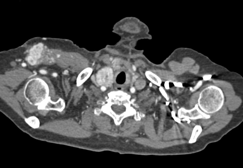 Metastatic Renal Cell Carcinoma to Muscle and the Pancreas - CTisus CT Scan