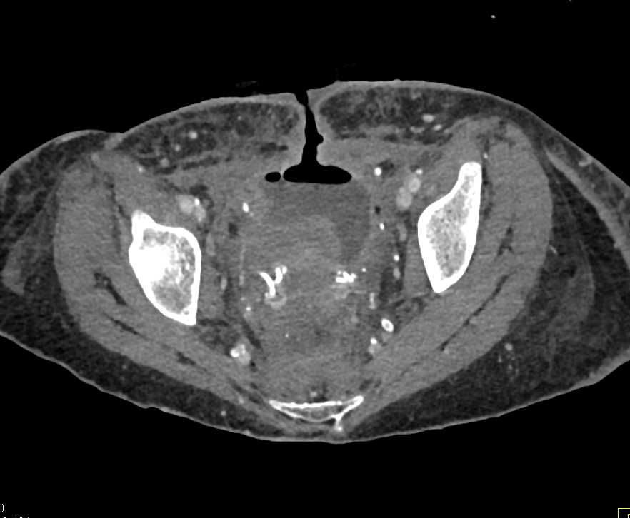 Pelvic Abscess Drains Through the Abdominal Wall - CTisus CT Scan