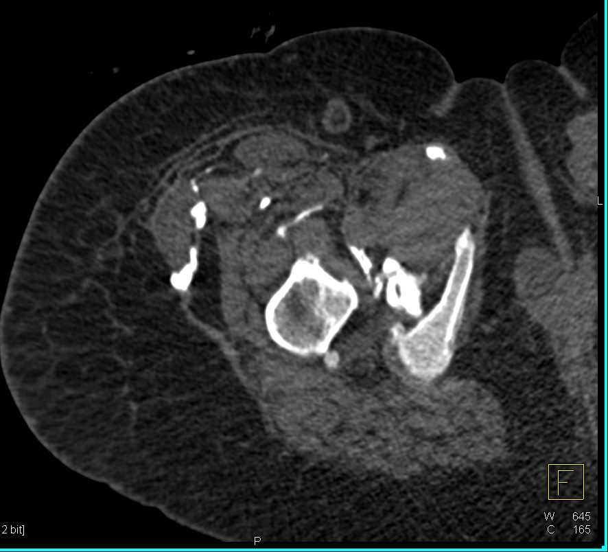 Muscle Calcification in Dermatomyositis - CTisus CT Scan