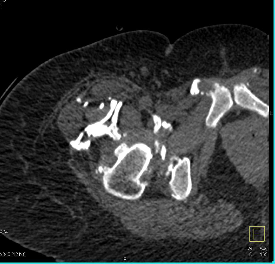 Muscle Calcification in Dermatomyositis - CTisus CT Scan