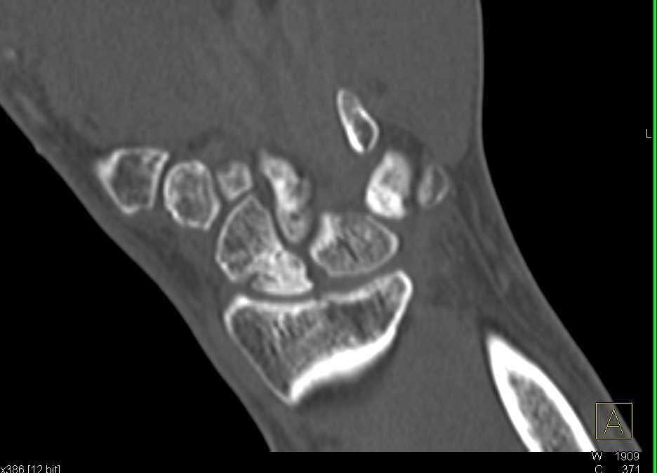 Nonunion of Scaphoid Fracture - CTisus CT Scan