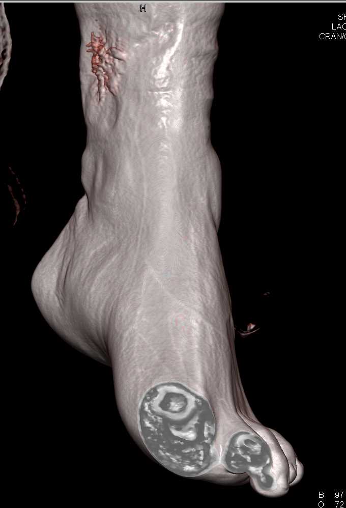 Healing Ulceration Lower Calf - CTisus CT Scan