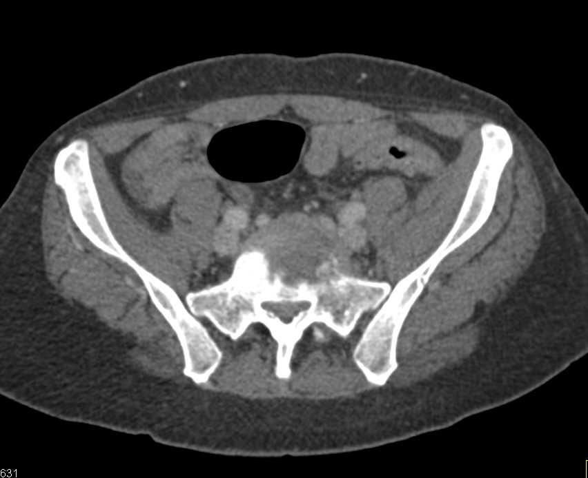 Osteomyelitis at the L5-S1 Level - CTisus CT Scan