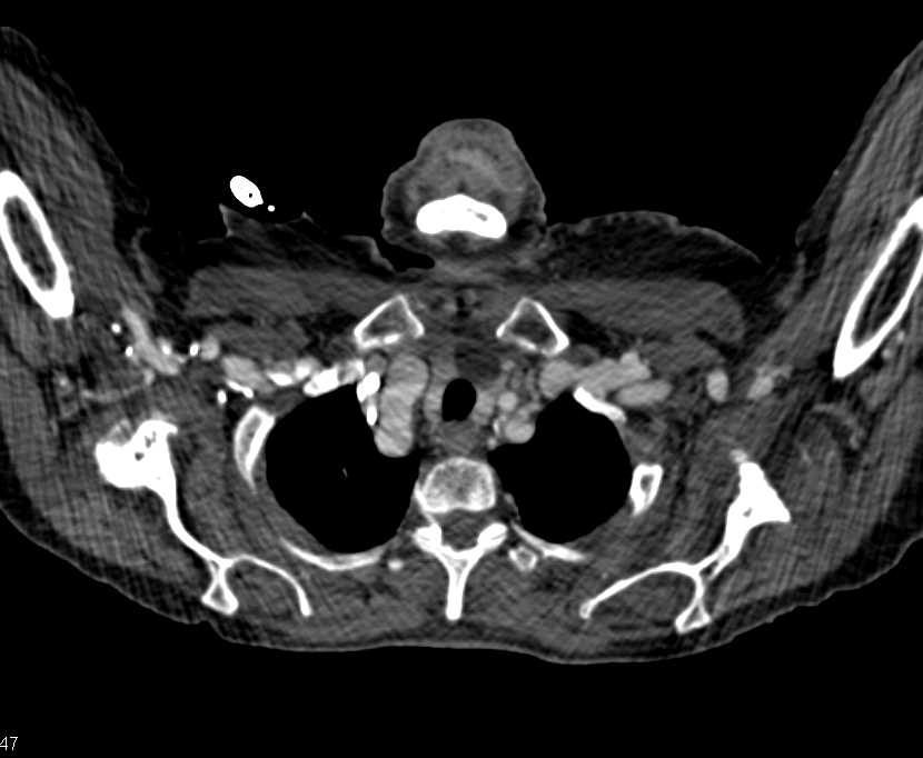 Arteriovenous (AV) Fistulae in Right and Left Axillary Zone - CTisus CT Scan