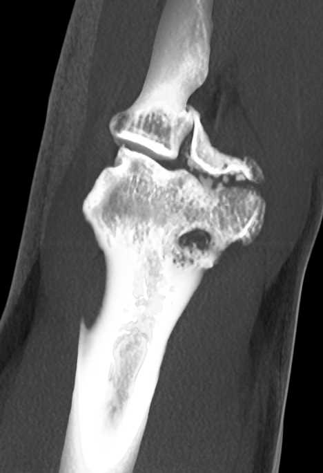 Pitchers Elbow with Multiple Joint Mice - CTisus CT Scan