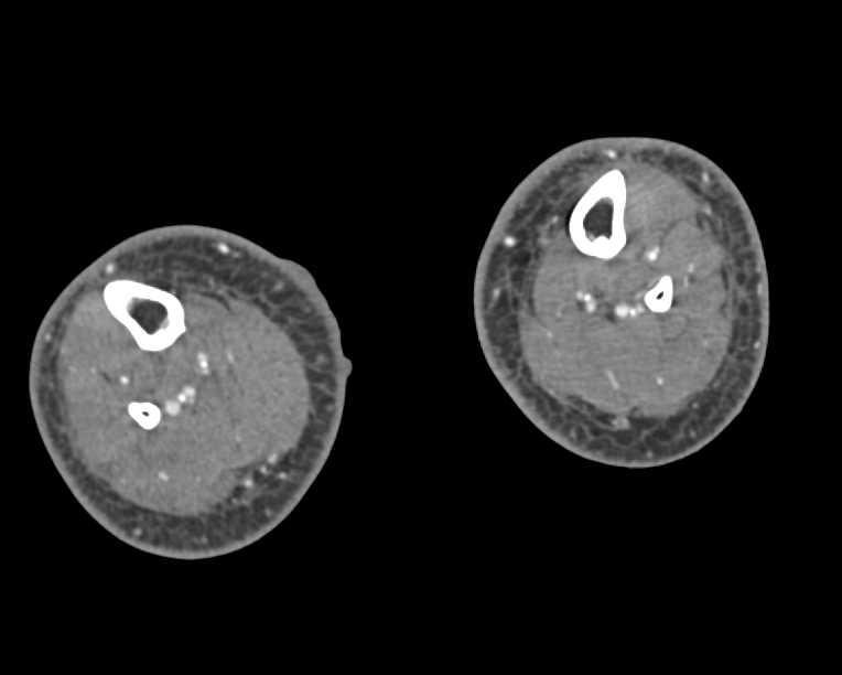 Blisters Right Calf and Cellulitis - CTisus CT Scan