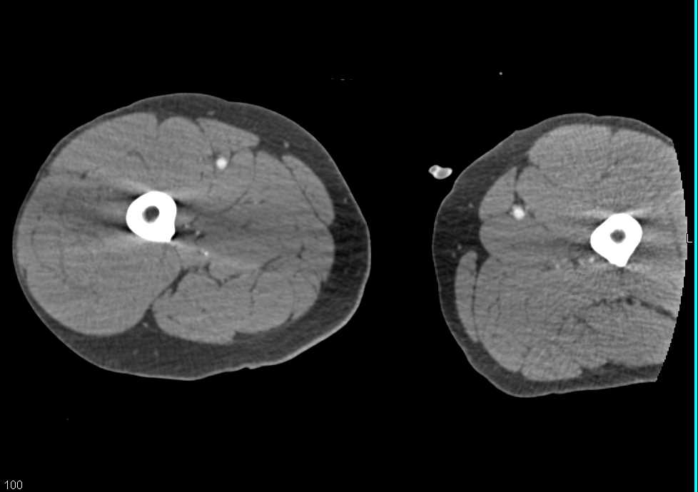 Comminuted Femur Fracture Without Vascular Injury - CTisus CT Scan