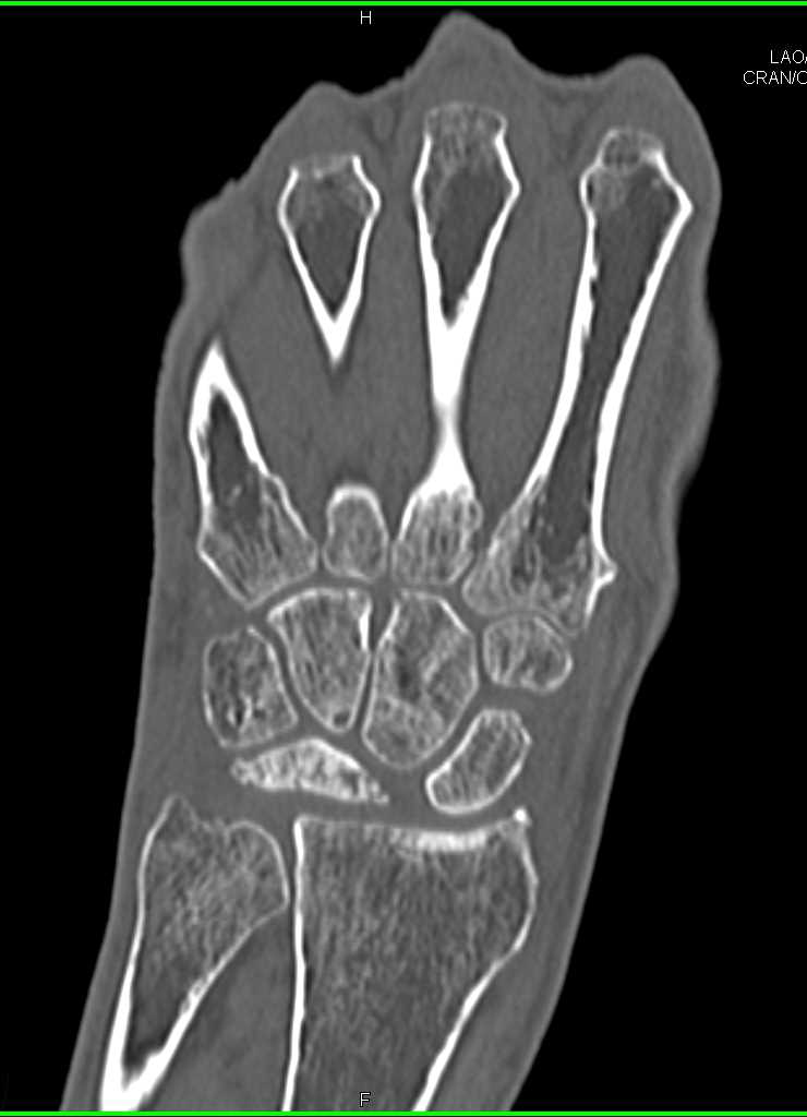 Avascular Necrosis Of The Lunate Following Reconstruc 5762