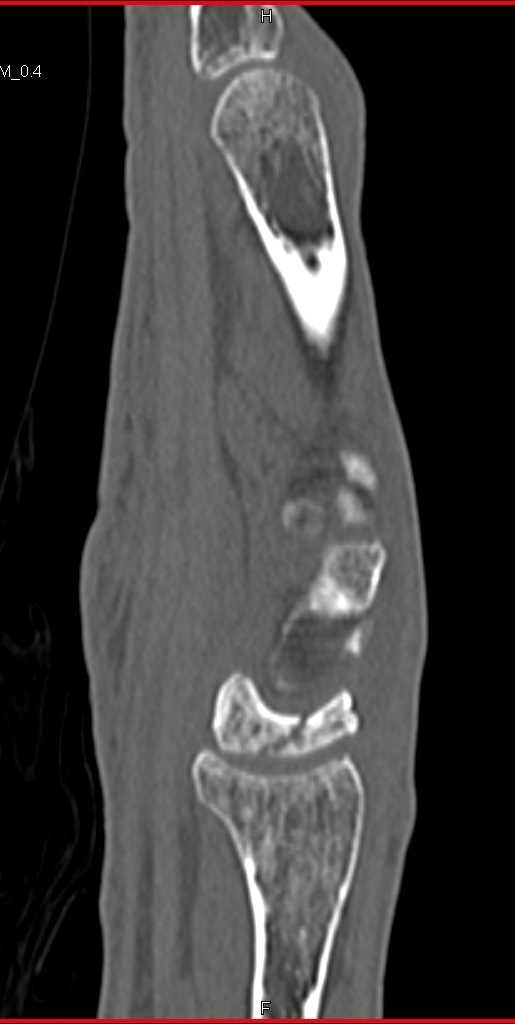 Fracture and Subsequent Avascular Necrosis Lunate - CTisus CT Scan