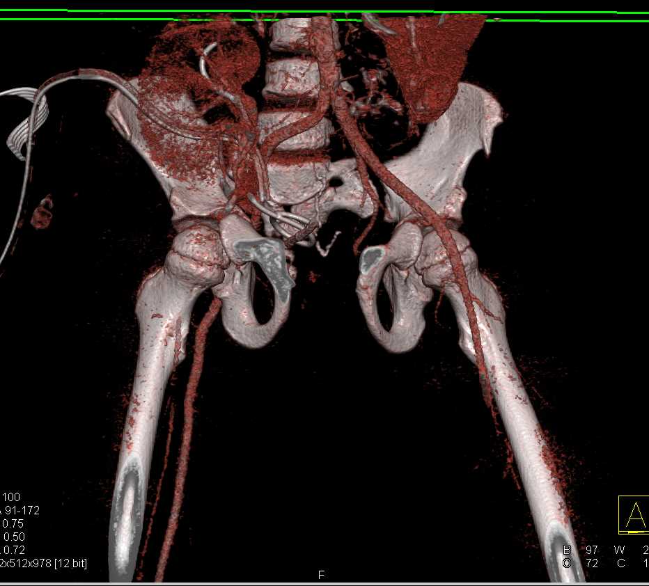 Diastase of the Symphysis Pubis in Patter with Bladder Exstrophy - CTisus CT Scan