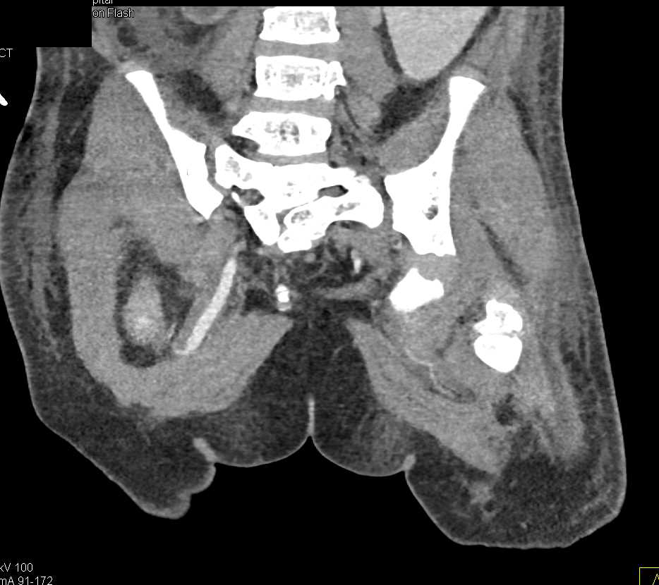 Diastase of the Symphysis Pubis in Patter with Bladder Exstrophy - CTisus CT Scan